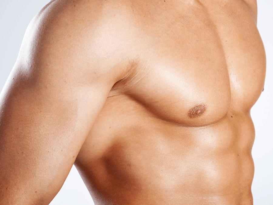 Gynecomasty