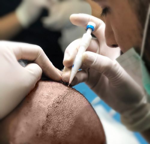 DHI Unshaved Hair Transplant