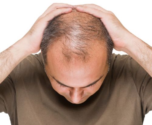 Chi si puo' sottoporre al trapianto di capelli ?