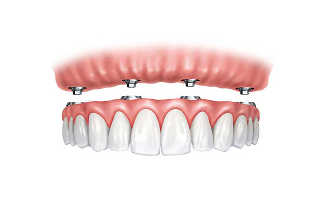 Denture Teeth