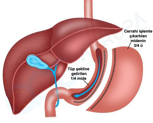 Stomach Tube Surgery